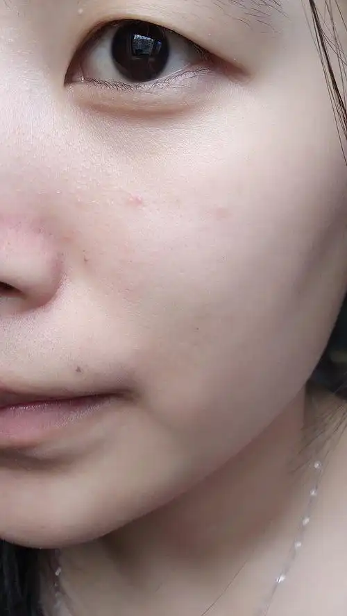 上图有没有人角质很薄然后鼻子两边的脸上皮肤一粒粒的