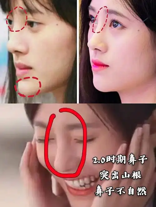 鞠婧祎为什么可以变成新整容模板