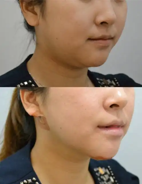 韩国宝士丽面部埋线提升对比案例