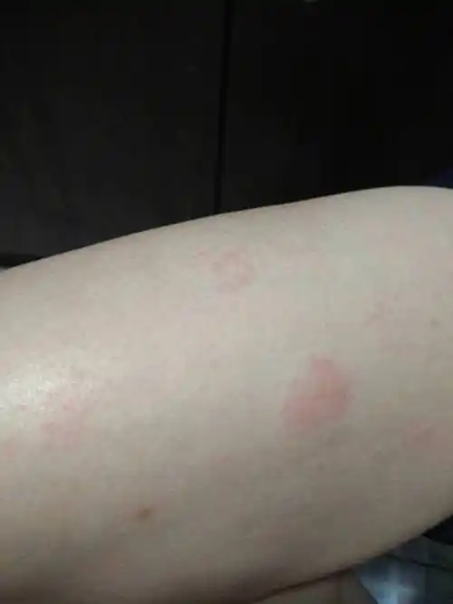 今天突然全身起这种疹子,像毛孔鼓出来的花斑形状的红疹子,瘙痒,我想