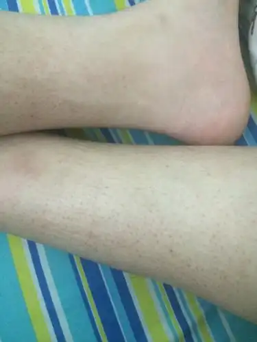 我小腿上这种是废弃物堵住毛孔了