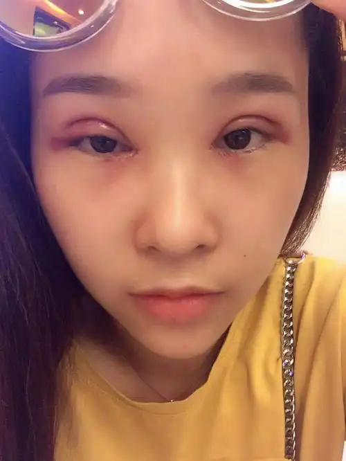 全切双眼皮 开内眼角术后21天了,恢复的好好哦