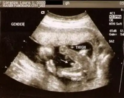 而三条线则是明显的女宝,如果没有看到明 显的三条线,就看两腿之间有