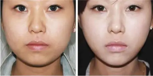 融化掉的脂肪随着时间的推移排除体外,随后便会渐渐的看到效果.