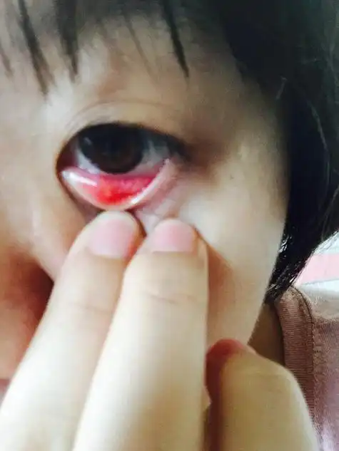 内麦粒肿哪位大神帮我看一下