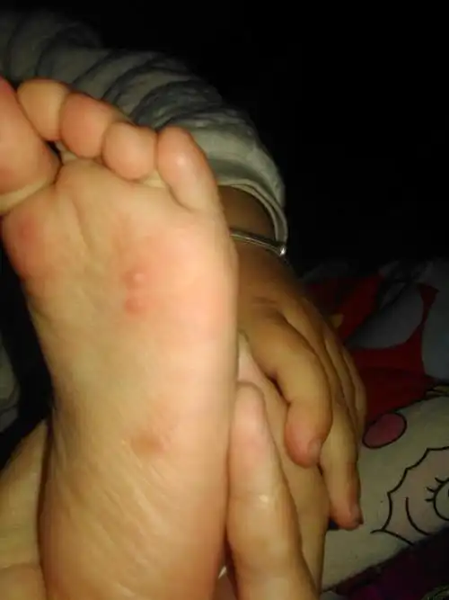 一岁半宝宝脚底下老是小疙瘩而且还痒,过两天就成水泡