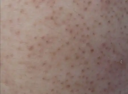 糠秕孢子菌毛囊炎怎样确认?