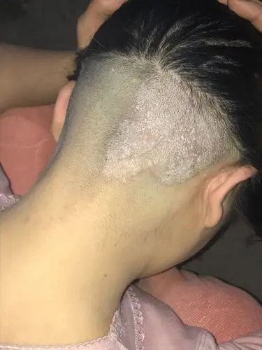 闺蜜头上的,这个是什么?说痒得不得了,一抓还有很多头皮屑.