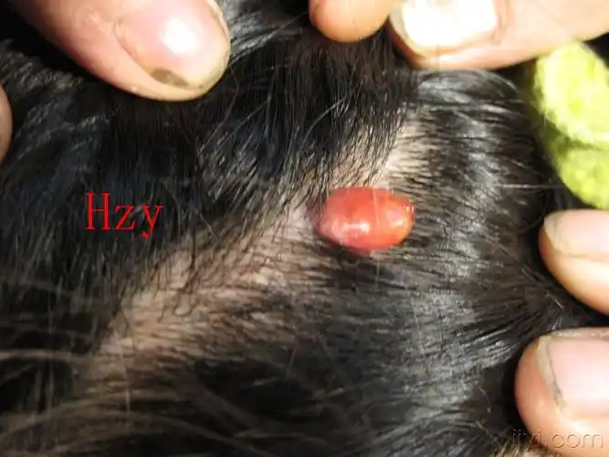 公布答案:化脓性肉芽肿 - 皮肤及性传播疾病讨论版 - 爱爱医医学论坛