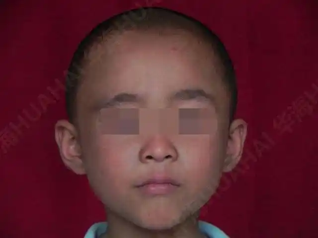 6岁儿童患白癜风被叫"白头怪",获免费救治康复