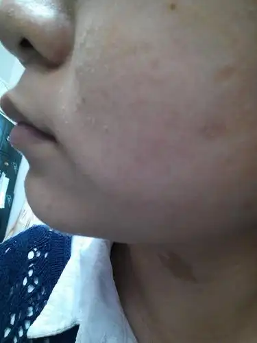 最近脸不知道怎么像冬天干裂一样脸粗粗的,干干的