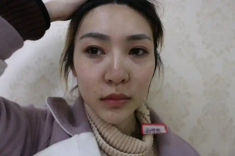 自体脂肪填充泪沟第四天眼睛下面出现了两个小包想问下这个小包是什么