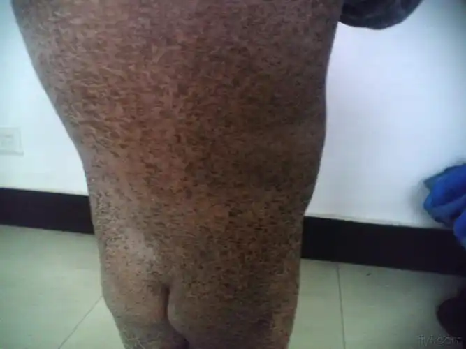 看图识病--寻常型鱼鳞病