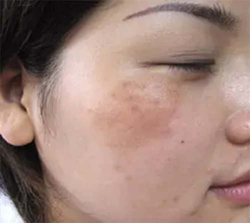 咨询_祛除黄褐斑加盟服务,供应-无锡奇肤堂皮肤病中医研究所