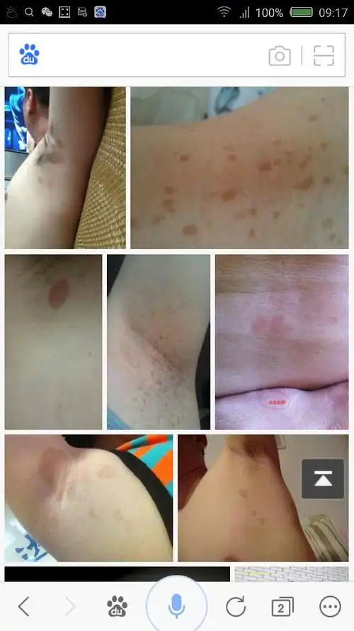 腋下长褐色圆斑图片