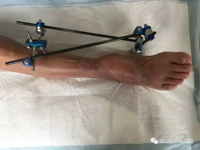 次日凌晨5时许,周大叔离断的下肢逐渐恢复红润,断肢再植术完成