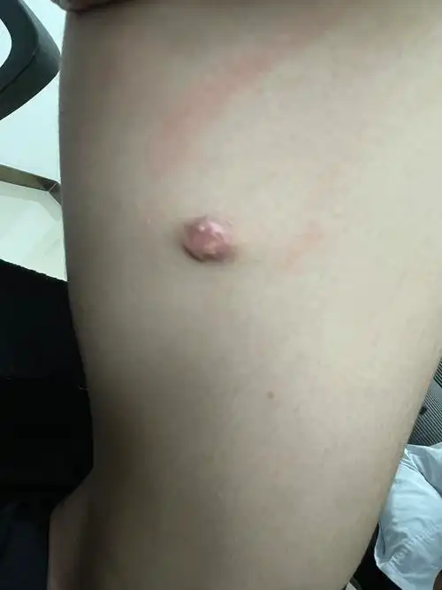 看图识病:钙化上皮瘤 - 好大夫在线