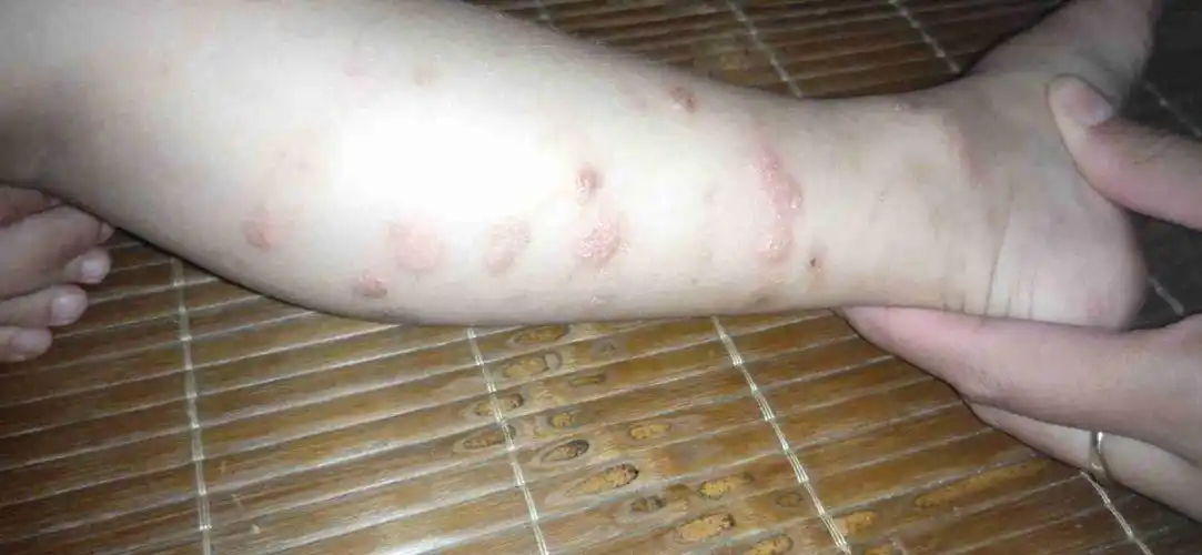 腿上长好多痒疙瘩