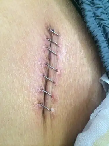 问:请问医生伤口这样可以拆线了吗,今天手术的第7天了