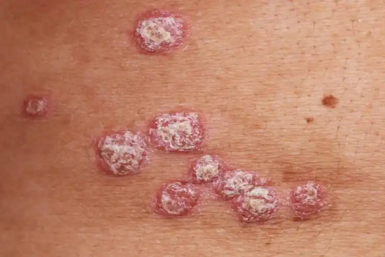 寻常型银屑病早期症状