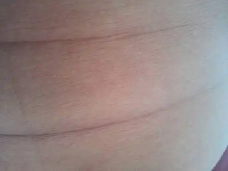 肚子上有一条坐出来的痕迹怎么能去除