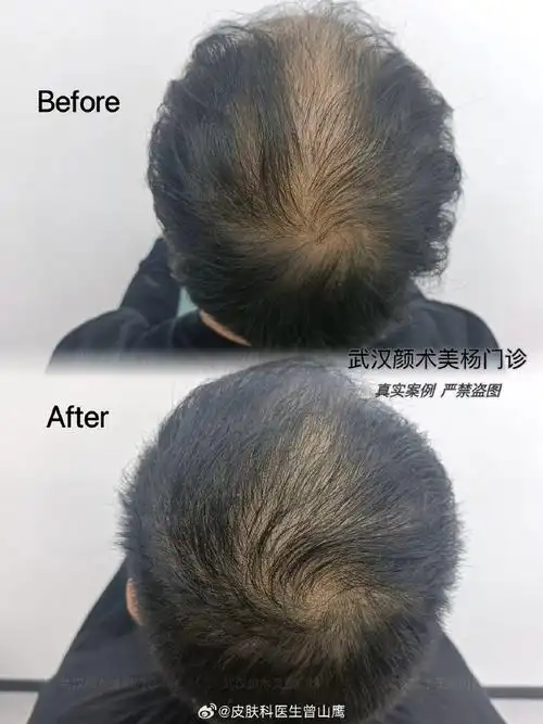 武汉颜术##脱发##脂溢性脱发怎么办##微博健康在关注##了不起的变美