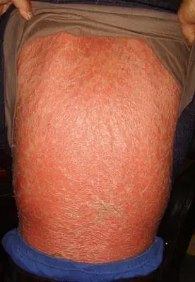 导致皮肤癣过敏的因素_成都银康银屑病医院