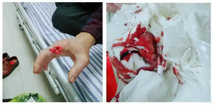 株洲有位大哥被毒蛇咬伤,他居然拿刀直接剁掉手指!