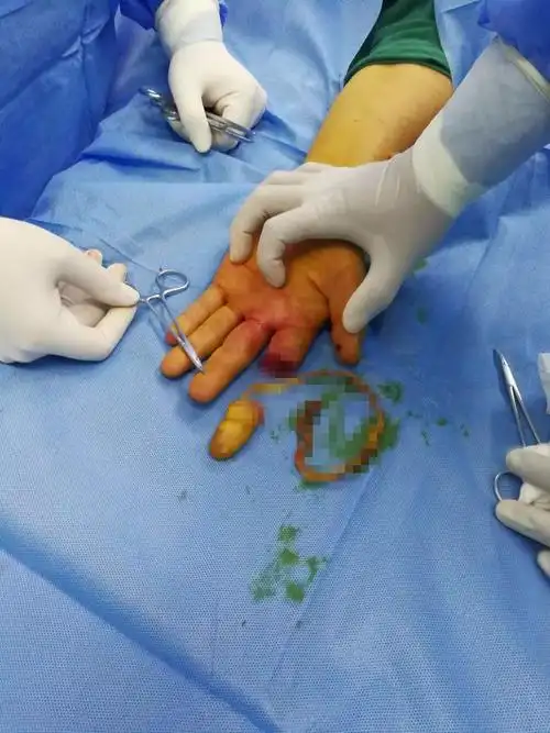 我院骨外二科成功完成一例高龄食指旋转撕脱离断再植术并成活