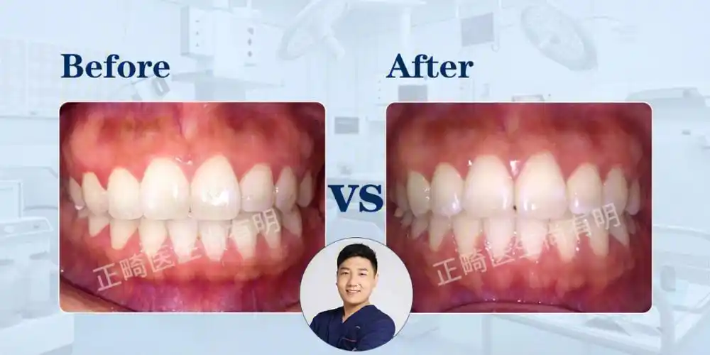 而且不影响咬合,其实可以忽视,但如果咬合已经不畅,那就更需要牙齿