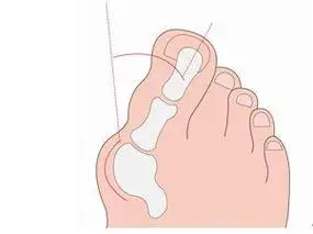 拇外翻最佳治疗方法