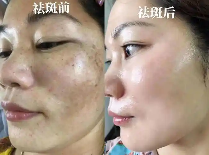 中国祛斑十大名牌,祛斑可参考它_肌肤_黑色素_色斑