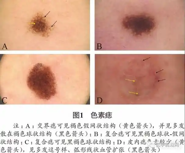 面部常见皮肤病皮肤镜诊断专家共识