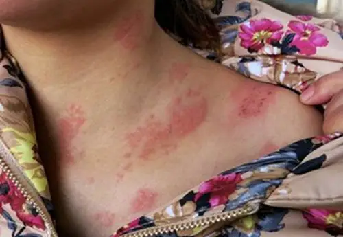 孕妇疥疮初期皮肤症状图片