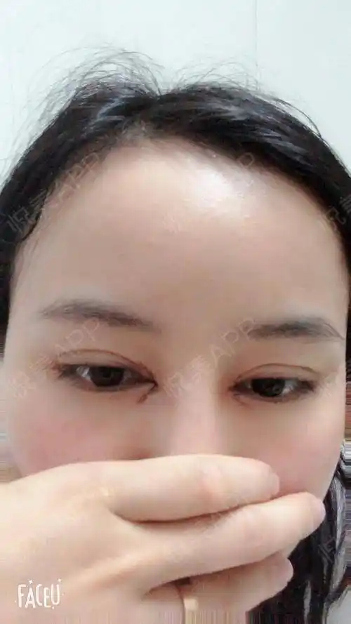 埋线双眼皮 开内眼角 术后1天