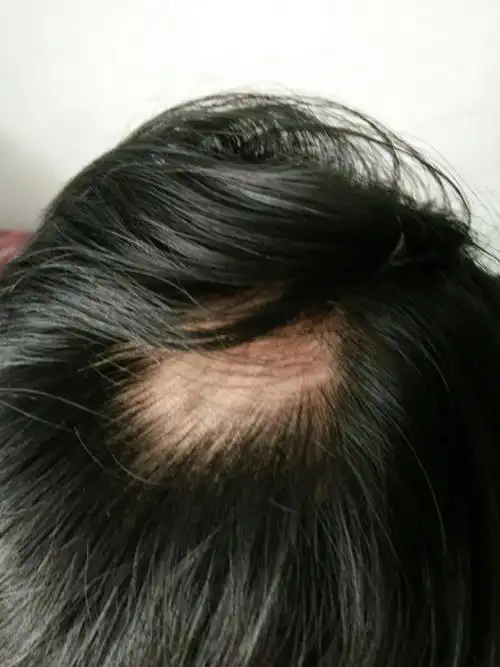 请问专家: 我后脑勺头发怎么会掉了一坨,是不是得了什么病,该怎样治?