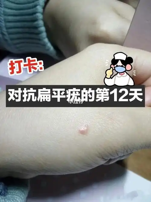 扁平疣是大学时候开始有的,当时回老家就很爱去次洗浴中心泡澡,搓澡