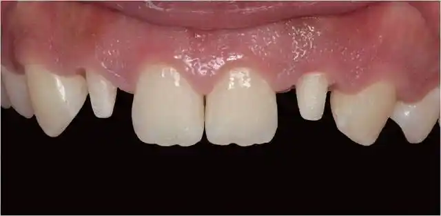 多学科联合治疗上侧切牙畸形过小牙一例——孙丽艳医师