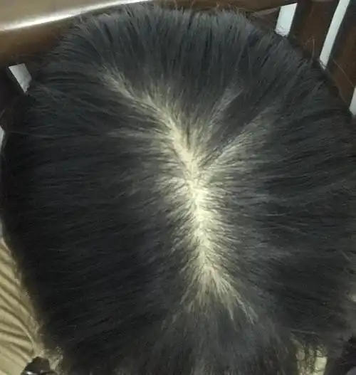 请问头秃成这样还有自救的方法吗