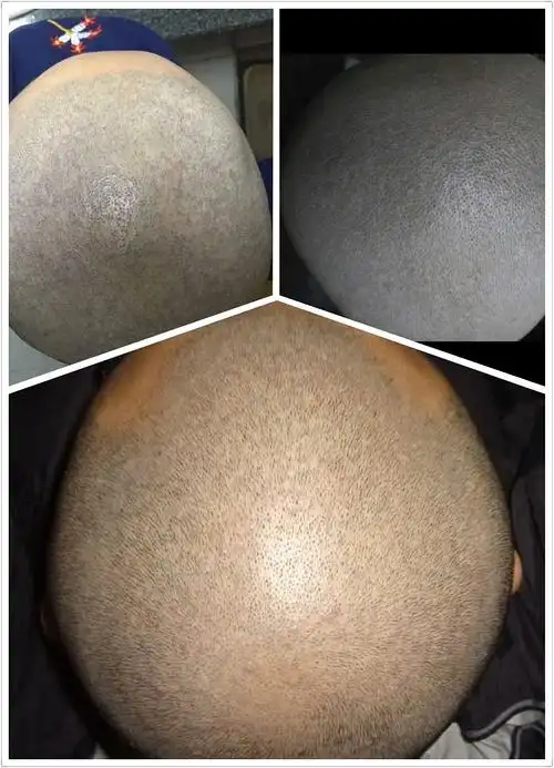 两个月的成果.以及和正常头皮毛囊对比