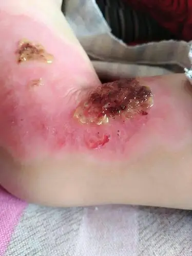 这是一个腿部烫伤的不足两岁儿童,用开水不小心烫伤,来我处求治,用了
