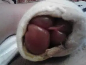 疾病大全 中医科 水肿 发布时间:2014-11-17 10:59:19