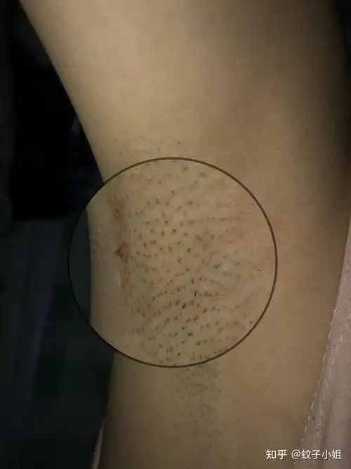 女生怎样脱腋毛