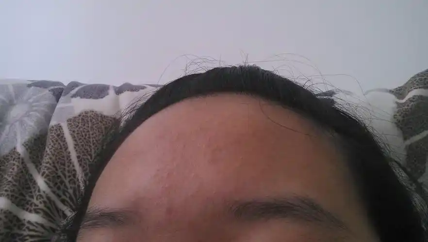 我的额头有很多小痘痘,这种痘痘有一点发白,大体上是呈皮肤色,还有几