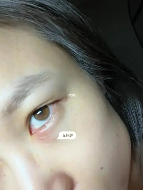就像淤青那种痛,眨眼会疼,后来就发现眼皮下肿了,一开始以为是带隐形