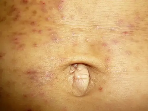 病例图片分享——接触性皮炎(皮带扣) - 皮肤及性传播疾病讨论版