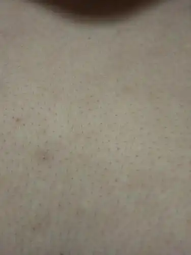 胸前起的这个白点是什么?