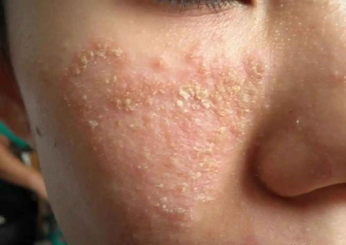 脂皮三年还有没有救?