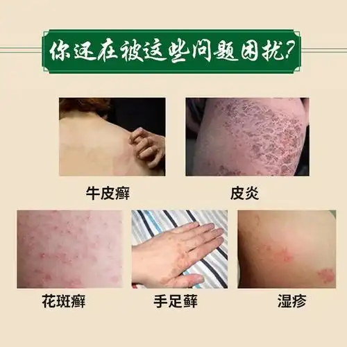 湿疹水头癣体癣体癣止痒皮肤癣软膏止痒膏百消膏湿毒皮毒清肤清湿