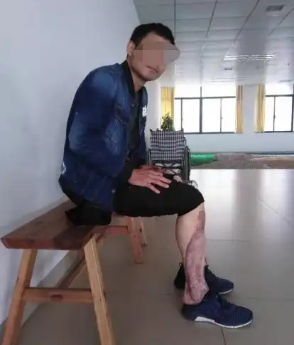 看,这个行走潇洒自如的帅哥,你们想不到他是个大腿截肢者吧!